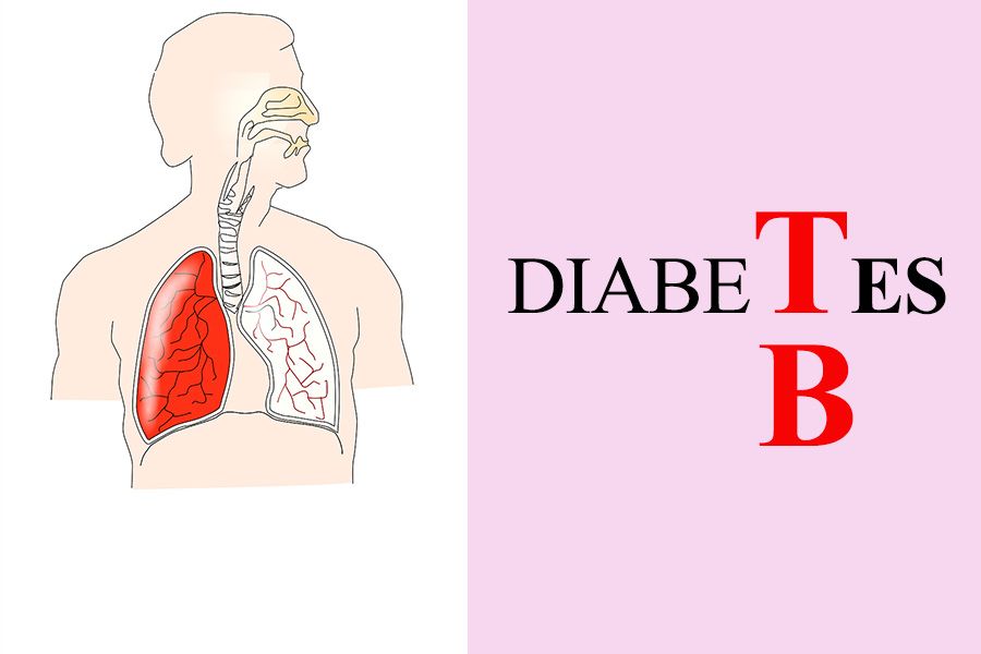 Type 2 Diabetes Mellitus Risk Factor for Tuberculosis