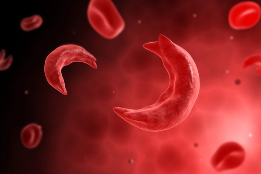 Sickle cell disease causes treatment