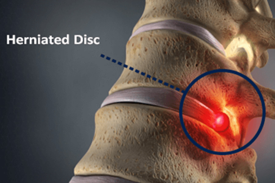 what is bulging disc or slipped disc