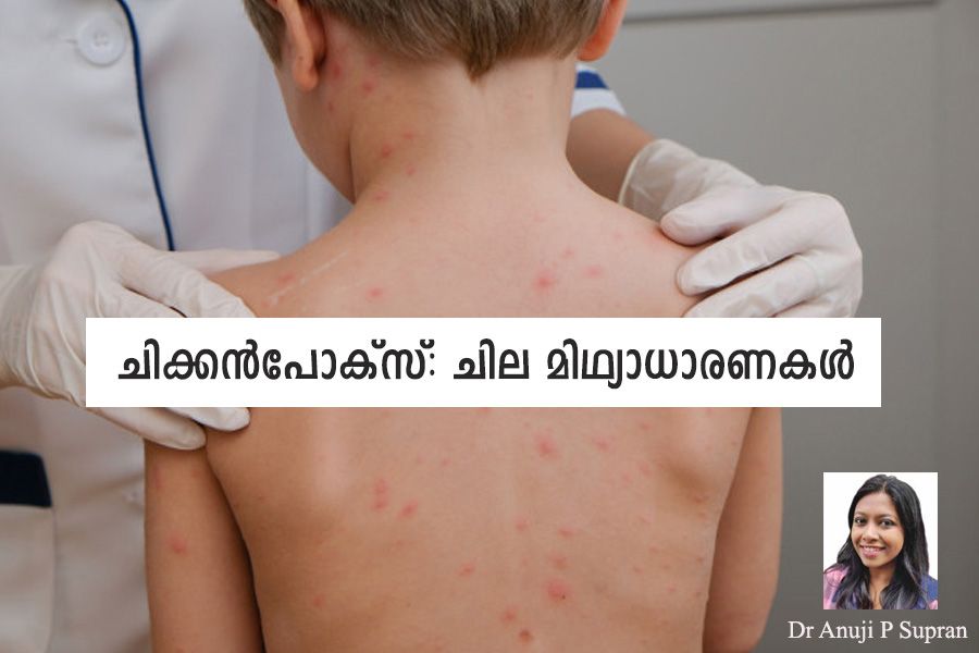 Chicken pox myths and facts article by Dr Anuji P Supran